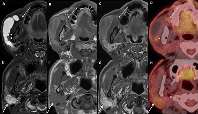 Primary malignant melanoma of the parotid gland, a rare case arising from a duct: a case report and literature review
